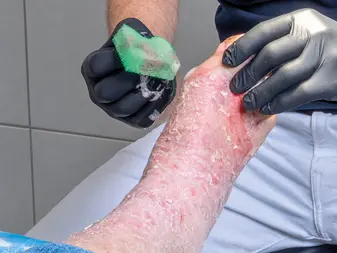 Mechanical wound cleansing is needed